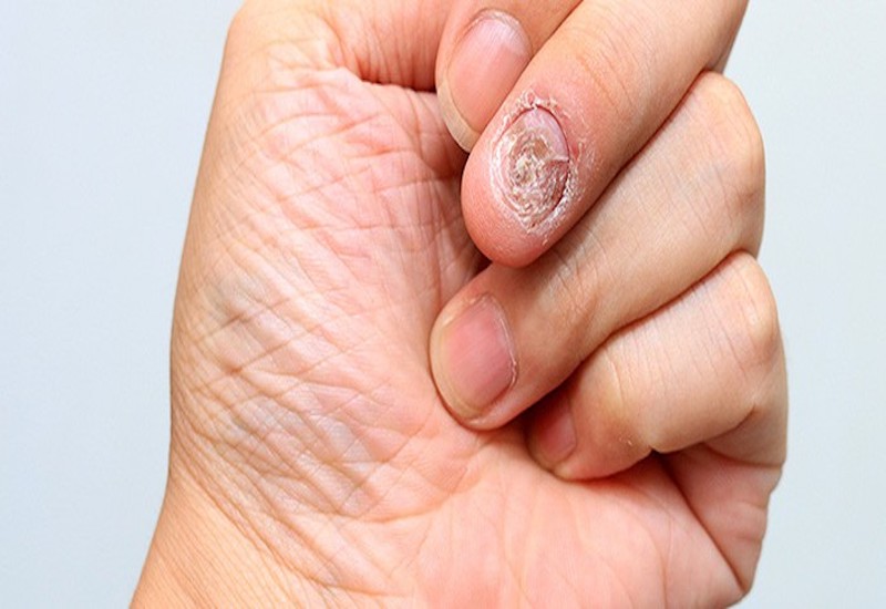 Nấm móng tay là một trong những tình trạng nhiễm nấm thường gặp nhất