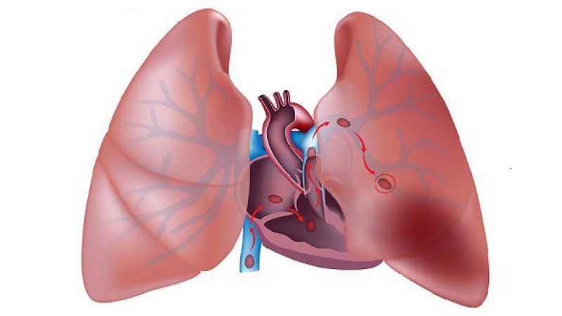 Sự hình thành cục máu đông dẫn đến tình trạng tắc nghẽn động mạch phổi