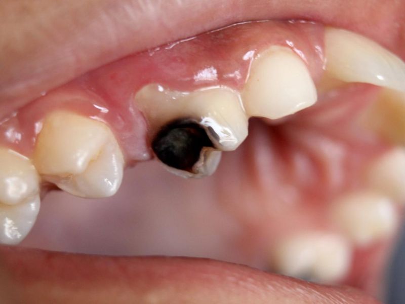 Tránh để sâu răng liên lụy tới tủy