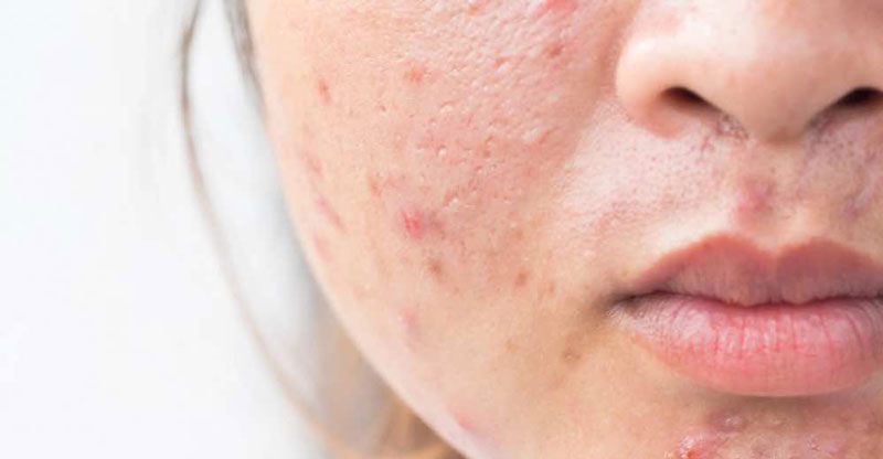 Các sản phẩm điều trị mụn thường có thành phần khiến da khô, sần sùi