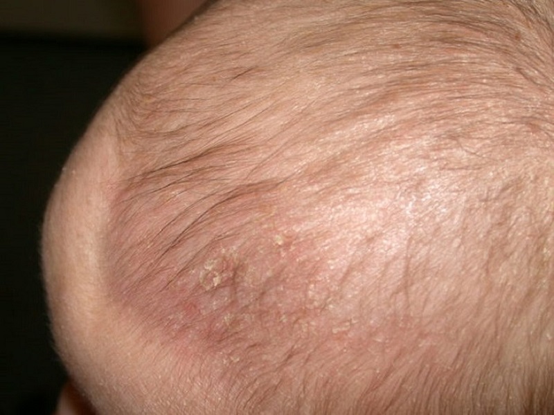 Bệnh nấm da đầu là một loại bệnh nhiễm trùng da đầu
