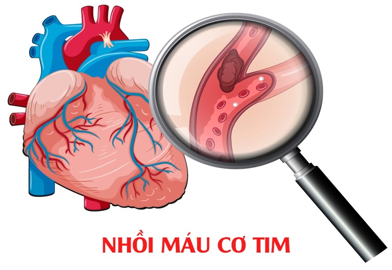 Nhồi máu cơ tim là biến chứng nguy hiểm do tình trạng tăng huyết áp gây ra