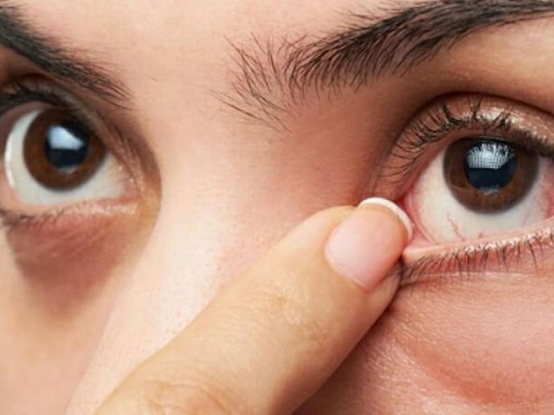 Hạt trắng nhỏ có thể xuất hiện ở một bên hoặc cả hai bên mắt