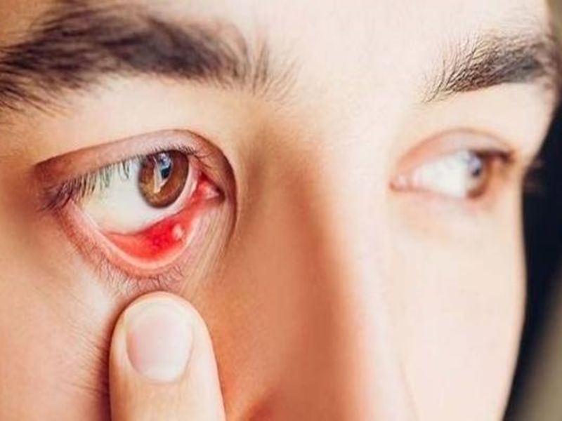 Đó là những triệu chứng cơ bản của tình trạng nổi hạt trắng tại mắt