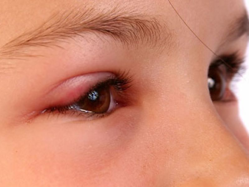 Nhờ bác sĩ tư vấn thuốc hỗ trợ điều trị lẹo mắt