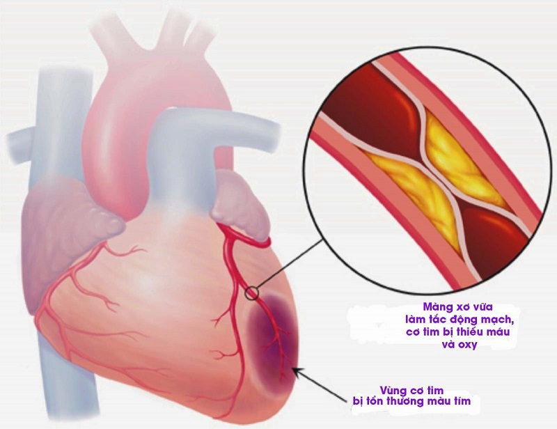 Biến chứng của cao huyết áp có thể dẫn đến nhồi máu cơ tim