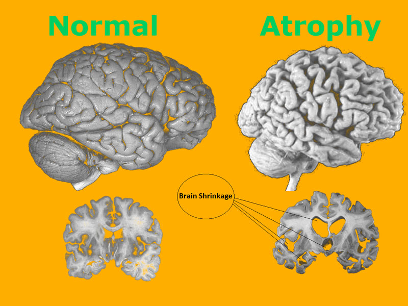 Bệnh teo não là một dạng bệnh lý thần kinh nguy hiểm