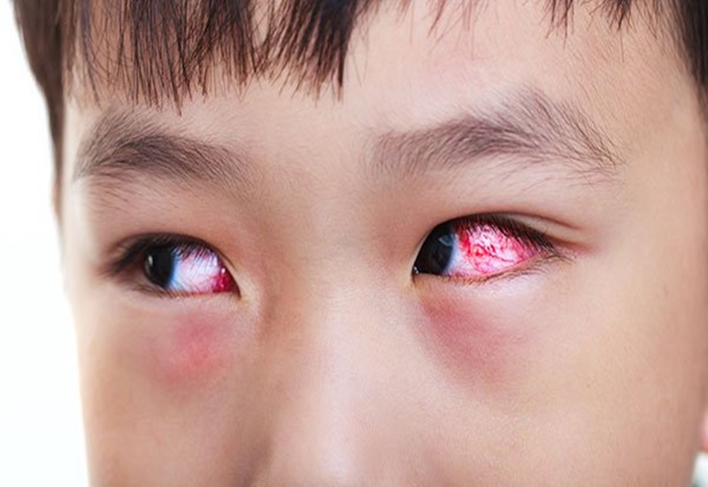 Đau mắt có thể xảy ra cả ở trẻ em và người lớn