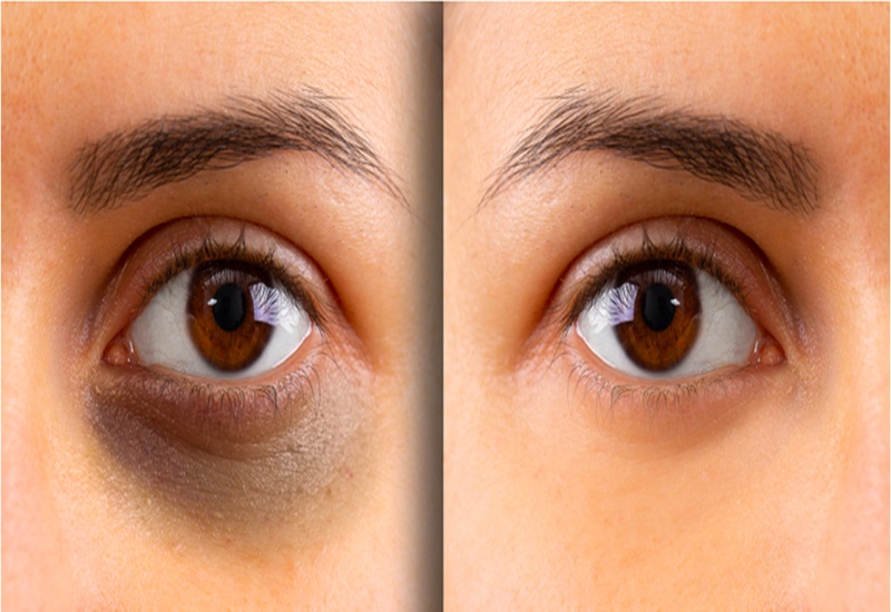 Tình trạng thâm mắt khiến bạn già hơn so với tuổi