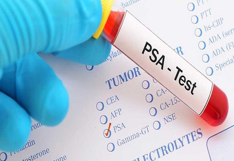 Xét nghiệm PSA thường được ứng dụng trong tầm soát ung thư tiền liệt tuyến