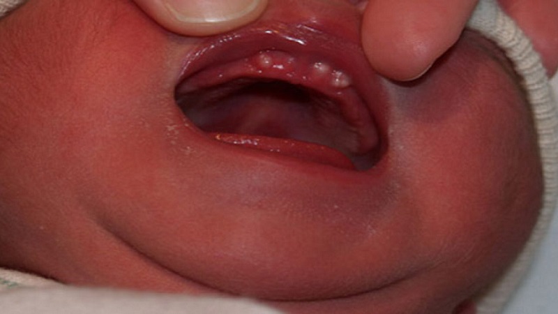 Nanh sữa thường xảy ra ở trẻ sơ sinh dưới 3 tháng tuổi