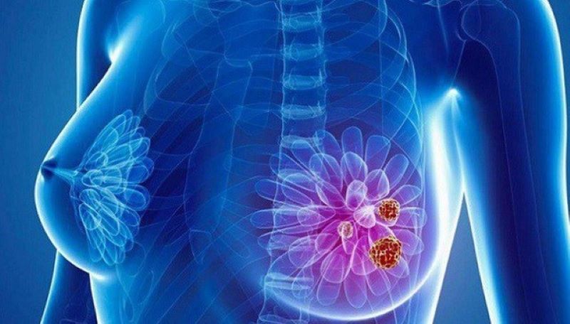 Một số dấu hiệu cảnh báo mắc ung thư vú: đau tức ngực hoặc tuyến vú, vú to bất thường, sờ thấy khối bất thường ở tuyến vú, nổi hạch nách