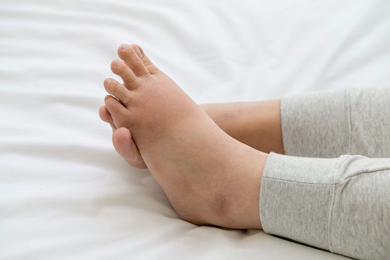 Bệnh nhi thường bị phù cổ chân