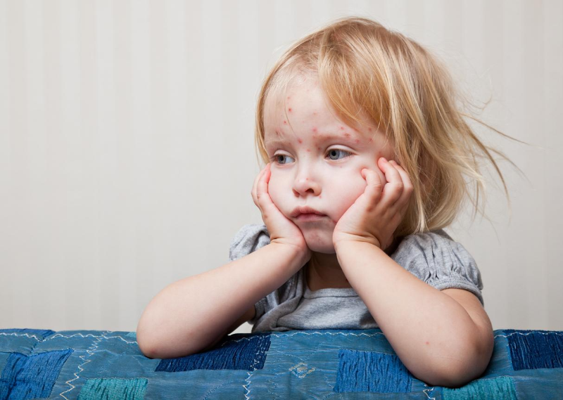 Biến chứng viêm tai giữa, đặc biệt là ở trẻ em có thể gây đau tai, giảm thính lực 