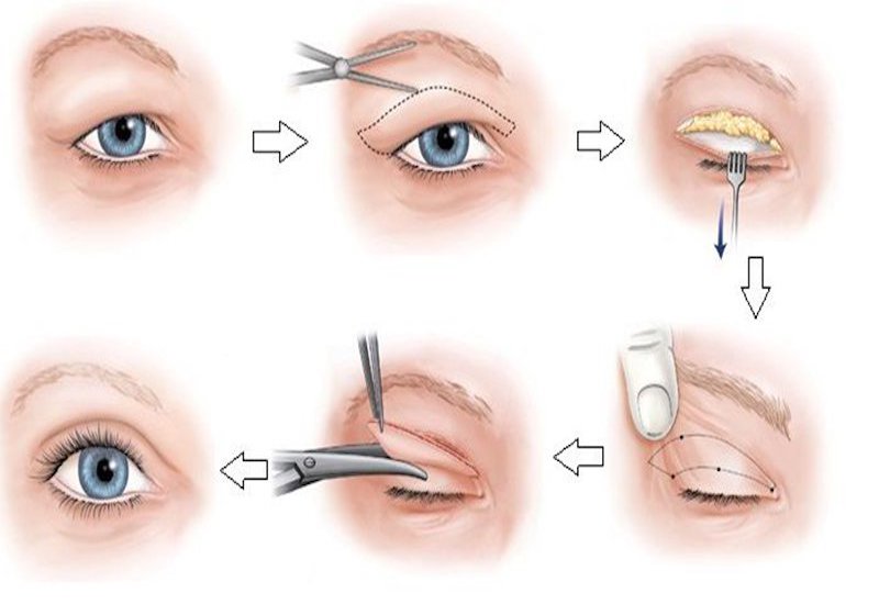 Quá trình phẫu thuật cắt mí để sở hữu đôi mắt 2 mí rõ nét