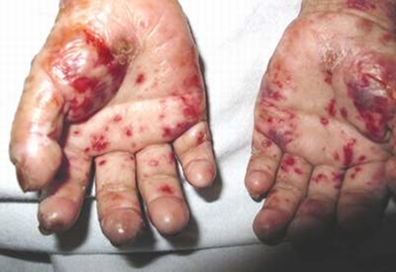 Người bệnh dễ gặp phải những tổn thương trên da