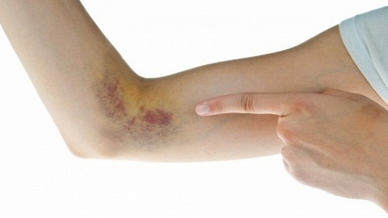 Người bị giảm tiểu cầu thường có các mảng bầm tím dưới da