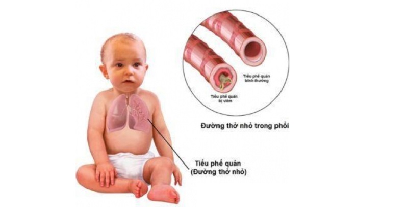Bệnh viêm tiểu phế quản thường xảy ra ở trẻ dưới 2 tuổi