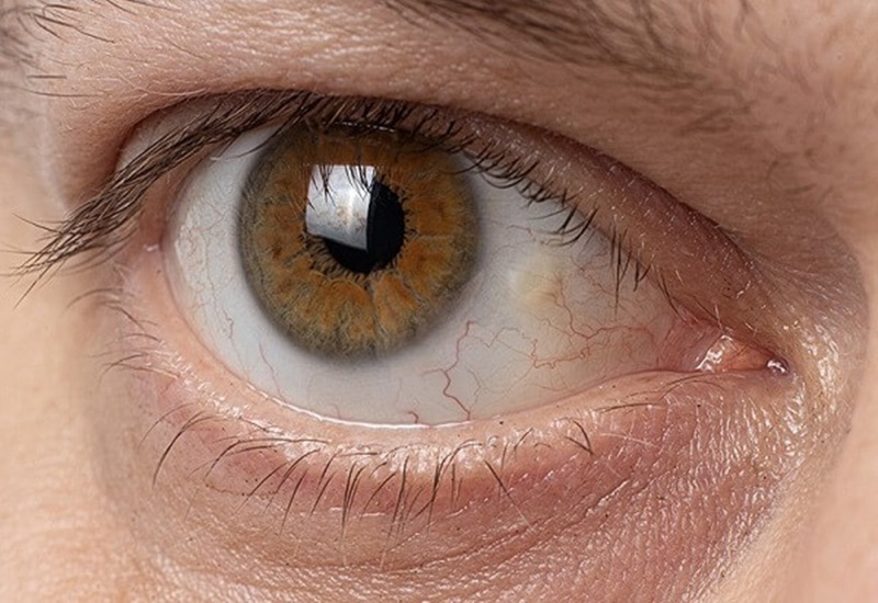 Mắt có đốm vàng là biểu hiện của bệnh mộng mỡ mắt