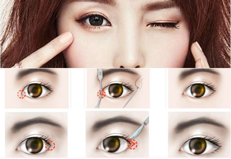 Mở rộng góc mắt giúp cải thiện khuyết điểm của mắt