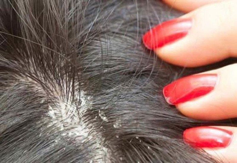 Nấm da đầu là bệnh về da rất phổ biến