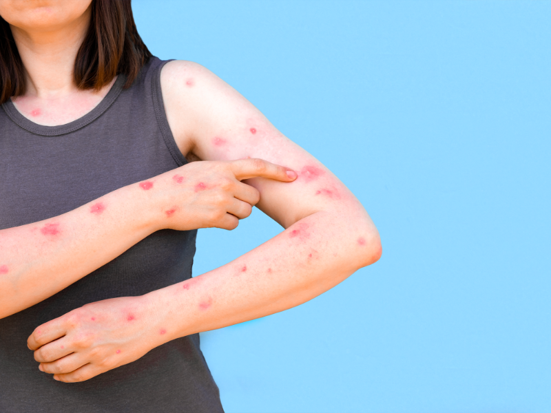 Triệu chứng đặc trưng của bệnh đậu mùa: mẩn đỏ trên da, ngứa, sốt và mệt mỏi