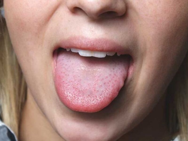 Đảm bảo sức khỏe cho lưỡi với các phương pháp y khoa