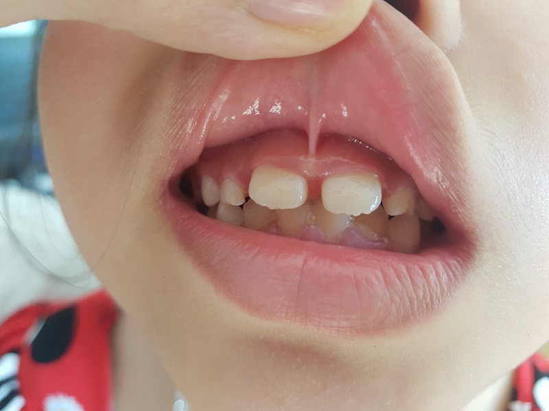 Thắng môi nằm ở khe giữa chân răng của hai răng cửa hàm trên
