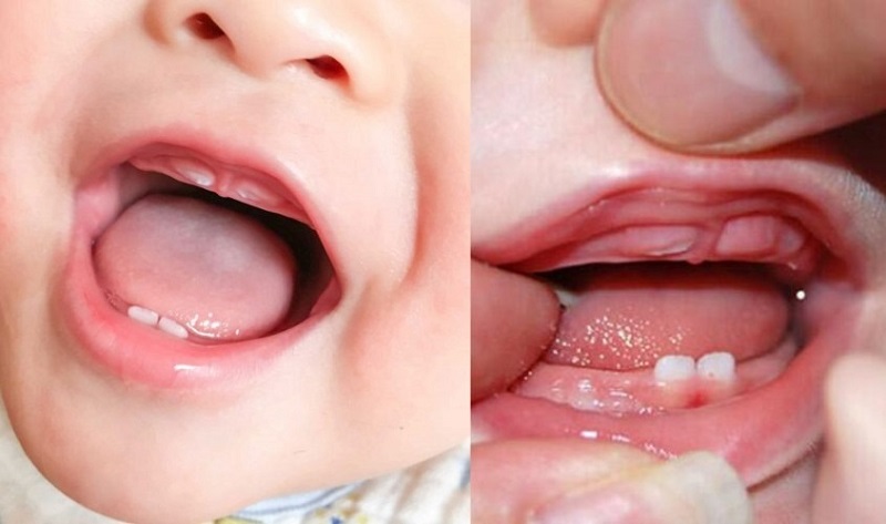 Phanh môi bám thấp ở trẻ được chia thành 4 cấp độ khác nhau