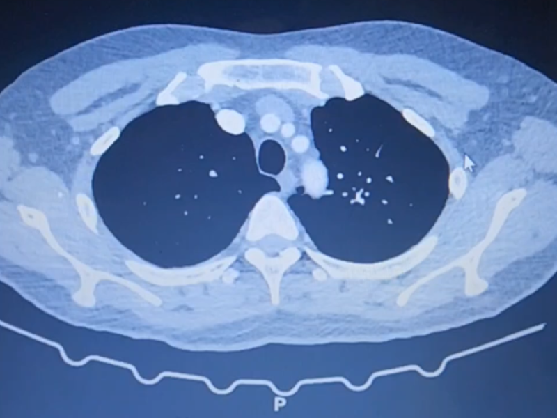 Kết quả chụp MSCT động mạch phổi phát hiện huyết khối lan tỏa trong động mạch phổi phải và động mạch phổi trái, đặc biệt bên phải