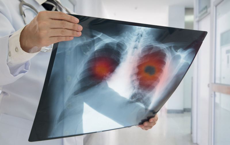 Chụp hình ảnh đánh giá sự phát triển của ung thư phổi