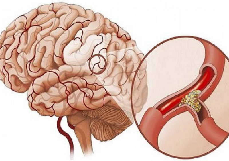 Xuất huyết não là tình trạng có cục máu tụ làm vỡ mạch máu não