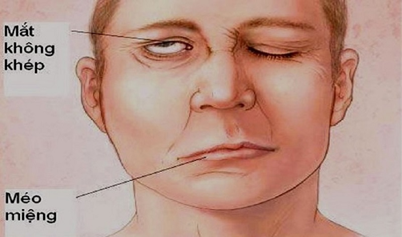 Người bị xuất huyết não thường gặp di chứng méo miệng, không khép được mắt