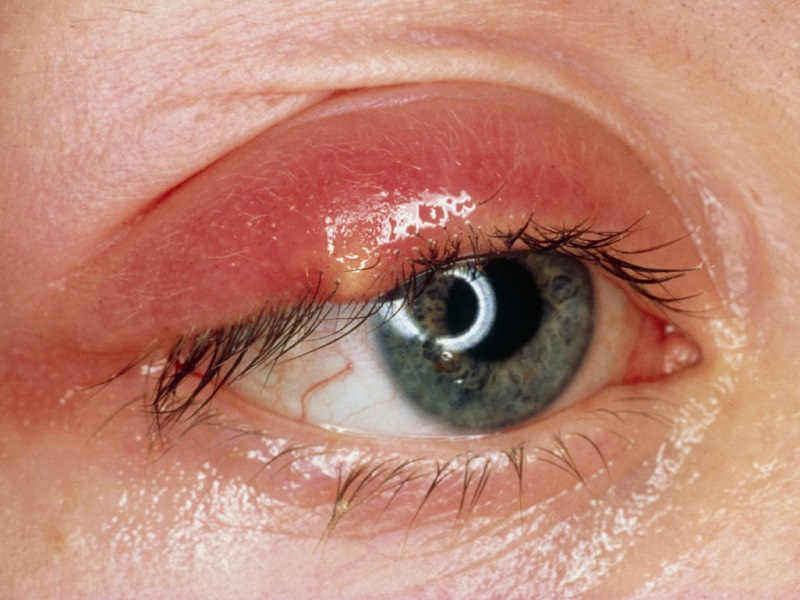 Lẹo mắt có thể gây nên tình trạng sưng viêm, ảnh hưởng đến tầm nhìn