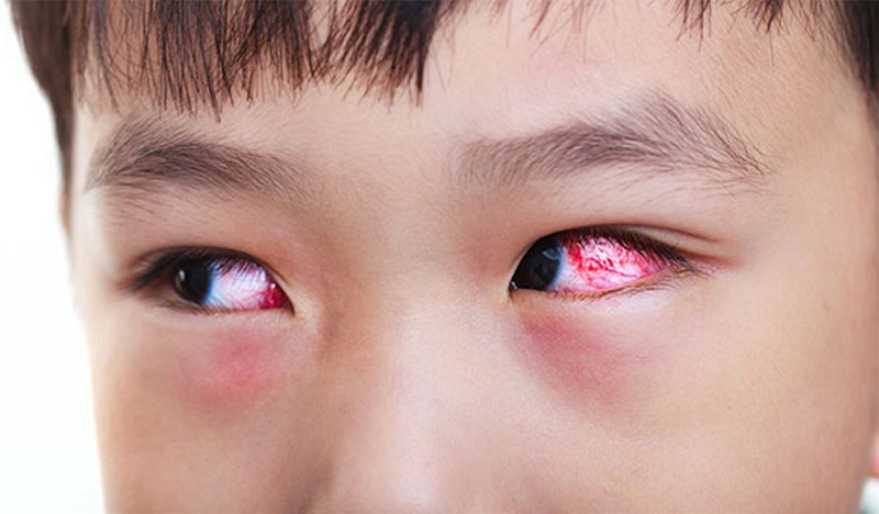 Thuốc mỡ tra mắt thường được chỉ định trong các bệnh lý viêm nhiễm cấp tính ở mắt
