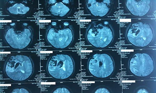 Phát hiện khối u bất thường khi chụp cộng hưởng từ não