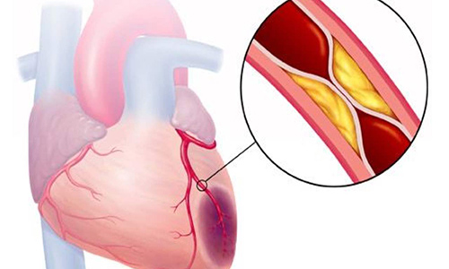 Chụp cộng hưởng từ tim mạch, kiểm tra động mạch vành