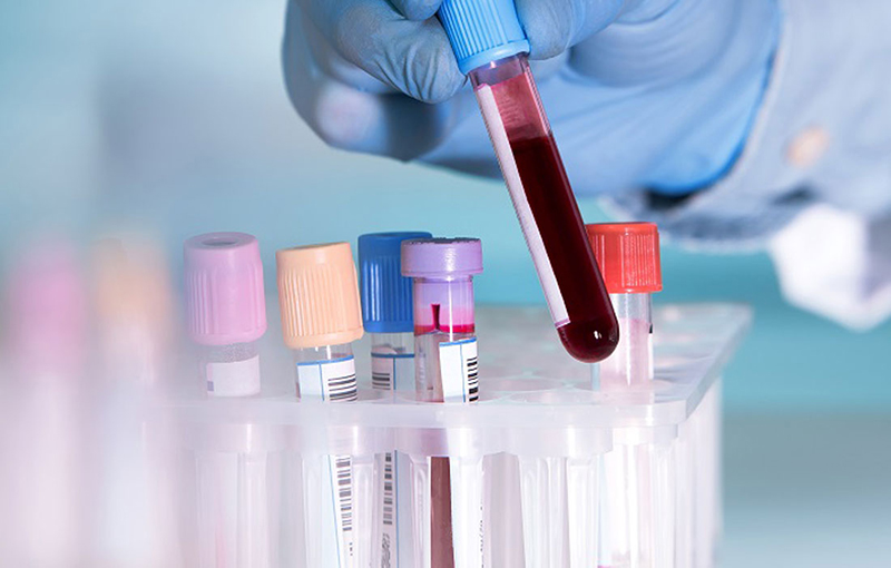 Phương pháp xét nghiệm máu thường được áp dụng để chẩn đoán nhiễm HEV