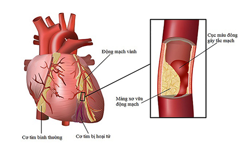 Nhồi máu cơ tim có thể được chẩn đoán chính xác qua hình ảnh chụp MRI tim