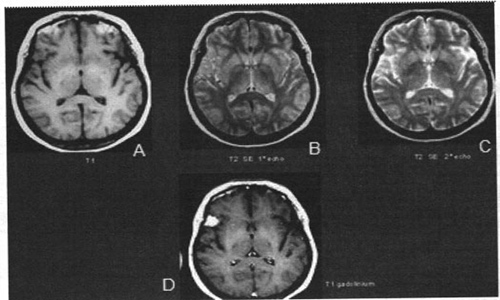 Chẩn đoán thần kinh qua hình ảnh chụp cộng hưởng từ não
