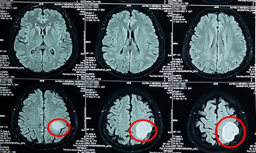 Phát hiện khối u não qua hình ảnh chụp cộng hưởng từ sọ não