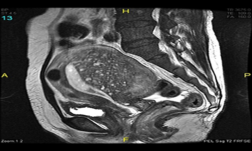 Chụp cộng hưởng từ tiểu khung phát hiện lạc nội mạc tử cung