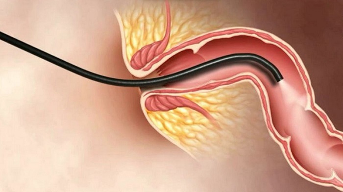 Hình ảnh ống nội soi đưa qua hậu môn vào bên trong quan sát lòng đại trực tràng