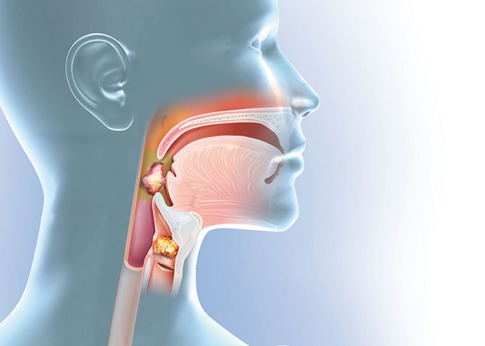 Nội soi giúp phát hiện các khối u thanh quản và vòm họng