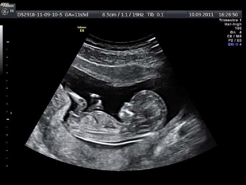 Hình ảnh siêu âm 2D của thai nhi có màu đen trắng