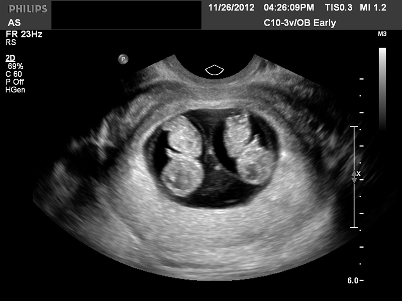 Hình ảnh siêu âm cho thấy người phụ nữ mang song thai