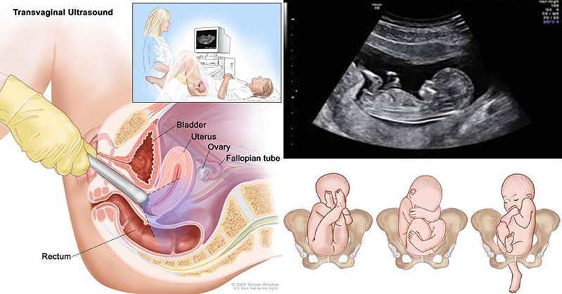Phụ nữ mang thai chỉ nên siêu âm đầu dò trong 3 tháng đầu