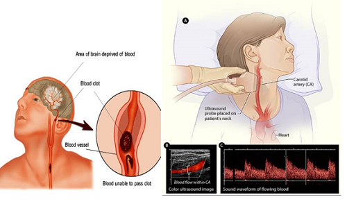 Siêu âm mạch máu giúp bác sĩ kiểm tra dòng chảy của máu trong các mô và cơ quan trong cơ thể