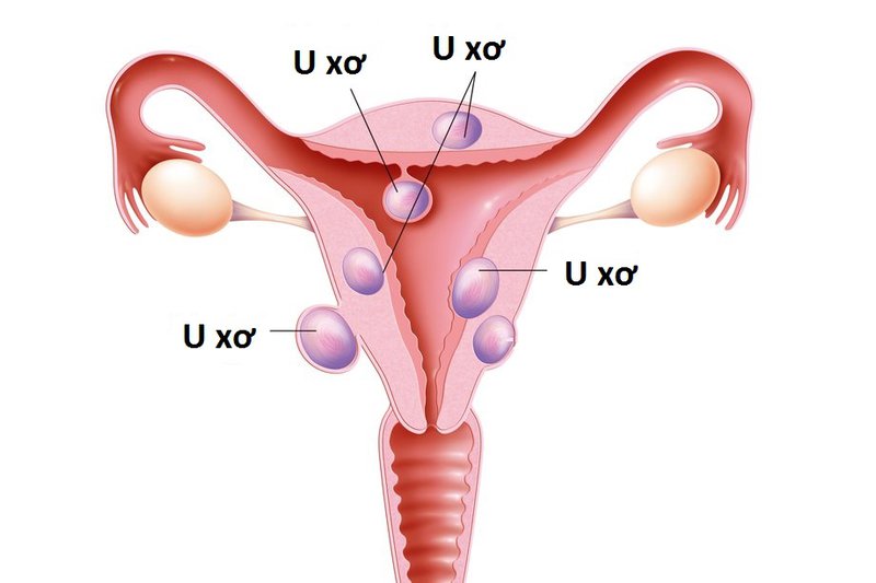 U xơ tử cung là một trong những nguyên nhân dẫn đến vô sinh ở nữ giới
