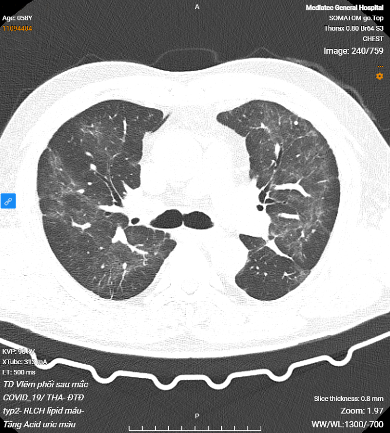 Hình ảnh tổn thương phổi của BN trên phim chụp CT